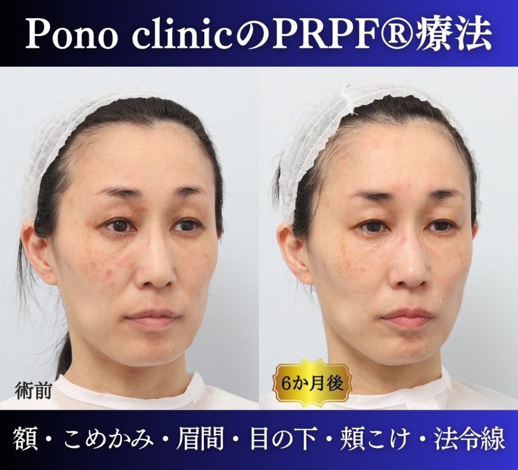 40代女性の症例、PRP注射、若返り治療 (1)