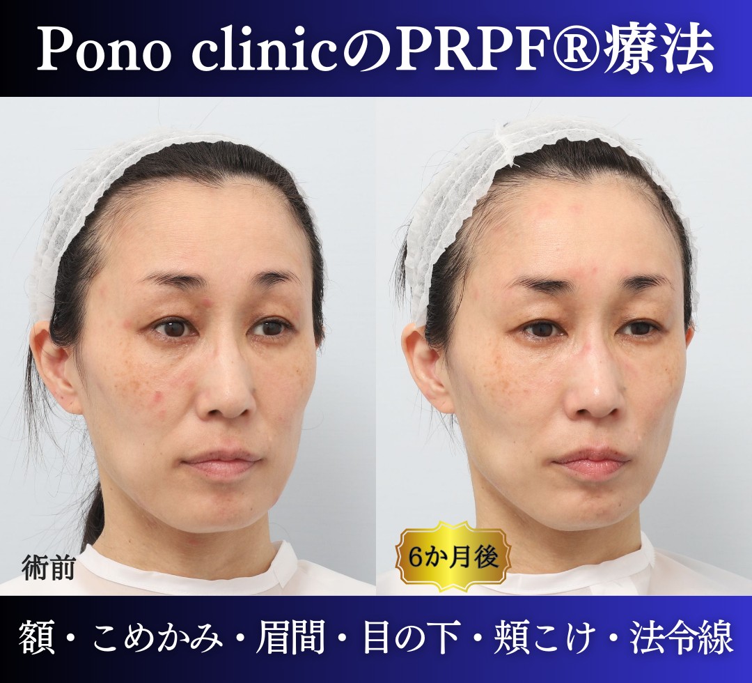 40代女性の症例、PRP注射、若返り治療 (1)