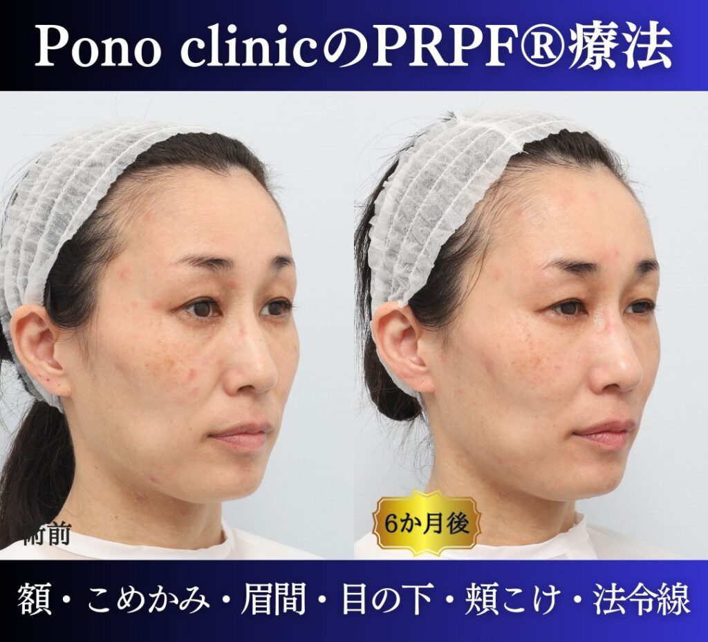 40代女性の症例、PRP注射、若返り治療 (2)