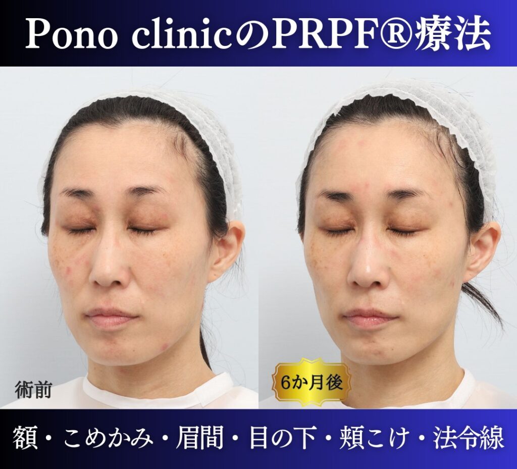 40代女性の症例、PRP注射、若返り治療 (3)