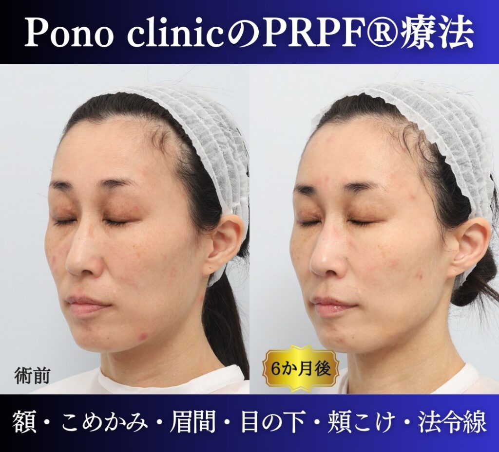 40代女性の症例、PRP注射、若返り治療 (4)