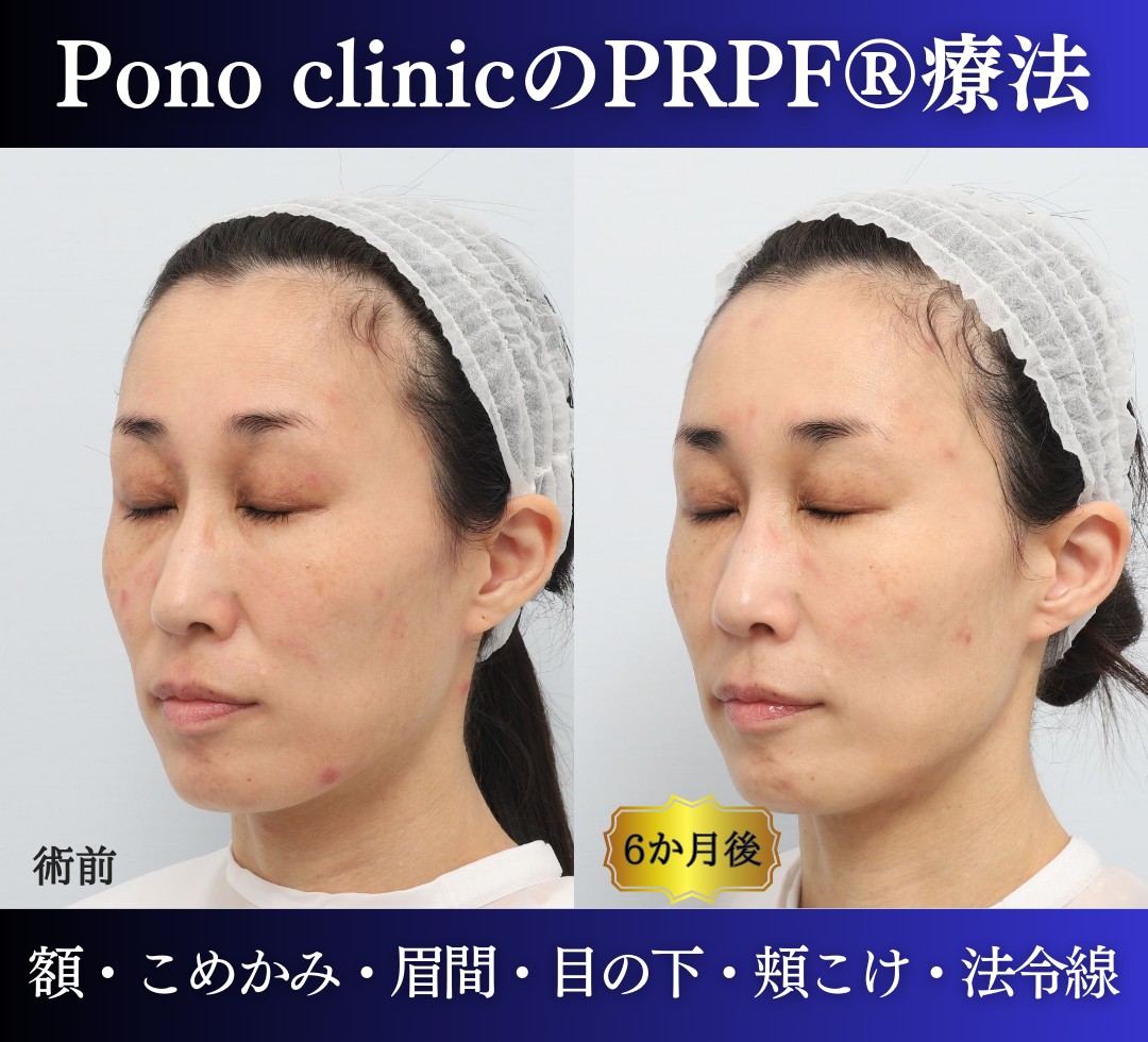 40代女性の症例、PRP注射、若返り治療 (4)