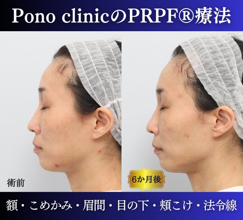 40代女性の症例、PRP注射、若返り治療 (5)