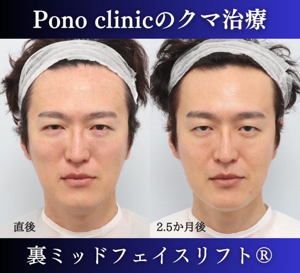 40代男性の症例、裏ハムラ法、目の下のクマ取り (1)