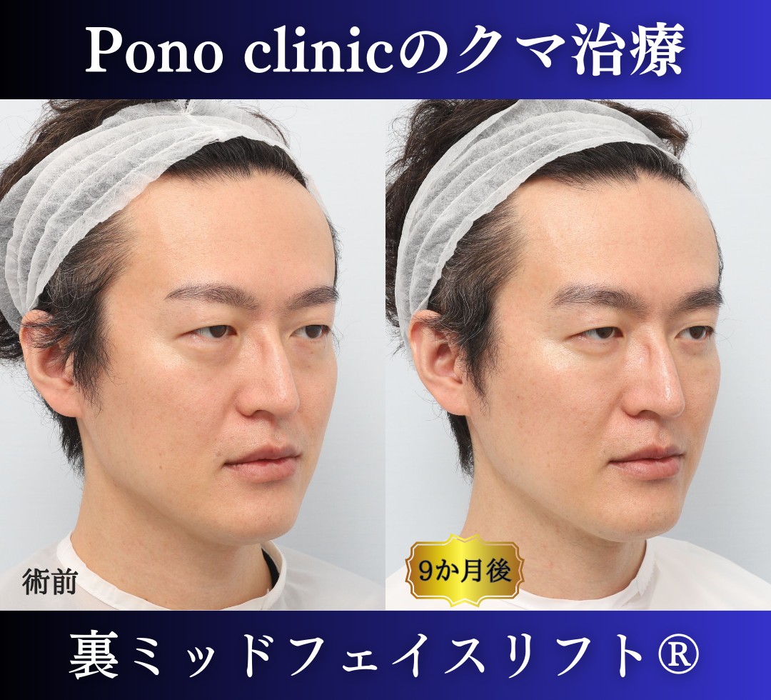 40代男性の症例、裏ハムラ法、目の下のクマ取り (2)