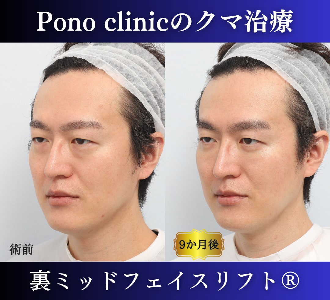 40代男性の症例、裏ハムラ法、目の下のクマ取り (3)