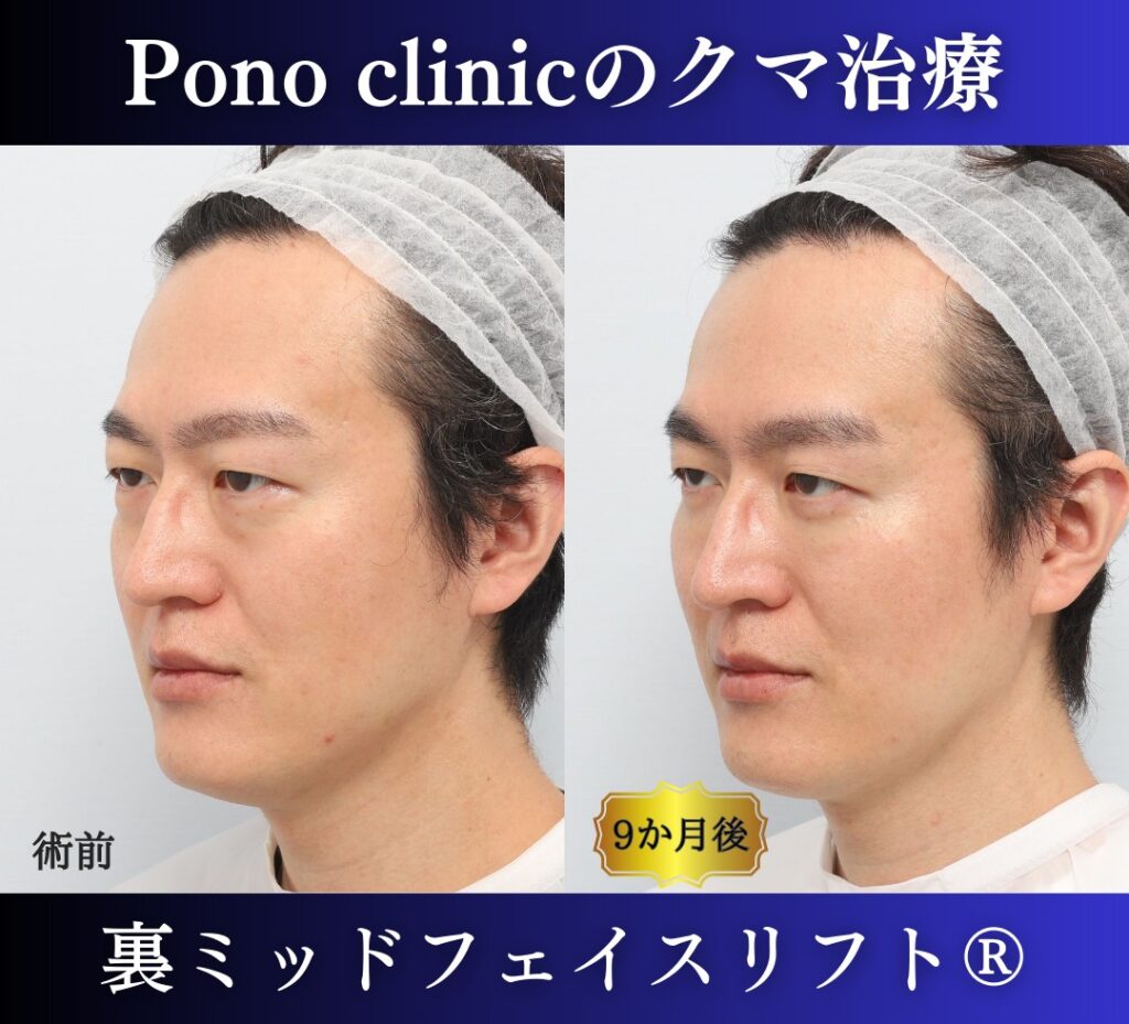 40代男性の症例、裏ハムラ法、目の下のクマ取り (4)