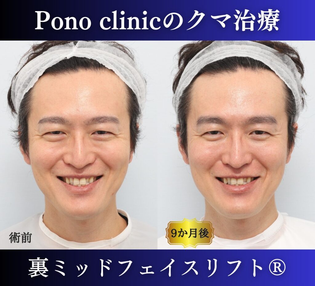 40代男性の症例、裏ハムラ法、目の下のクマ取り (5)