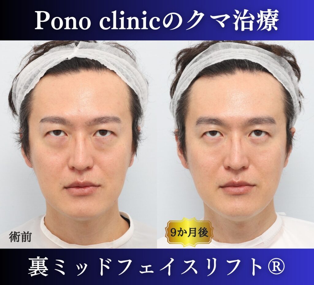 40代男性の症例、裏ハムラ法、目の下のクマ取り (6)