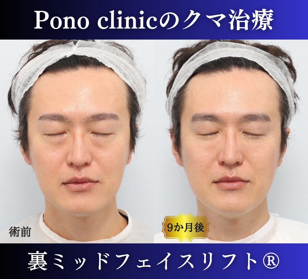 40代男性の症例、裏ハムラ法、目の下のクマ取り (7)