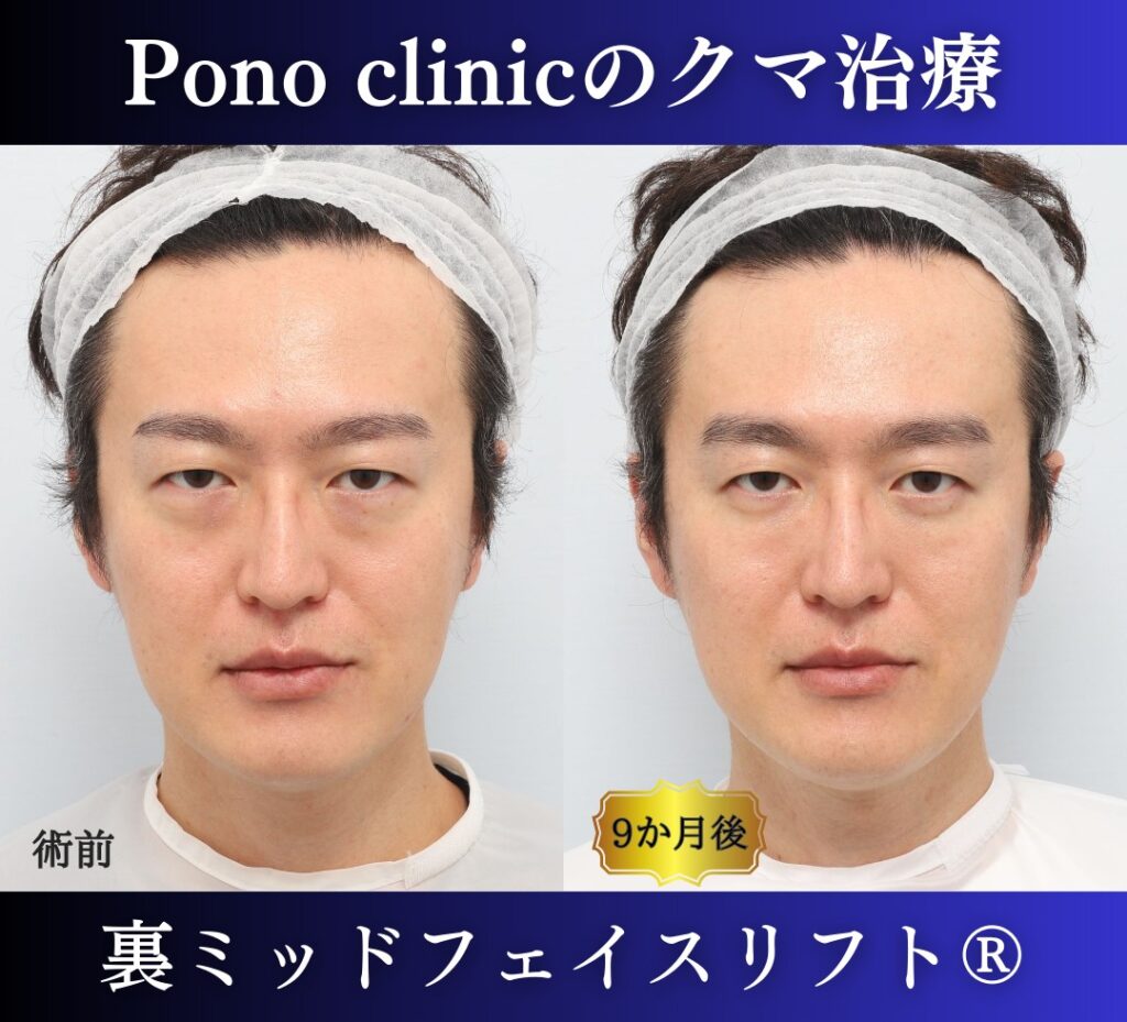 40代男性の症例、裏ハムラ法、目の下のクマ取り (8)