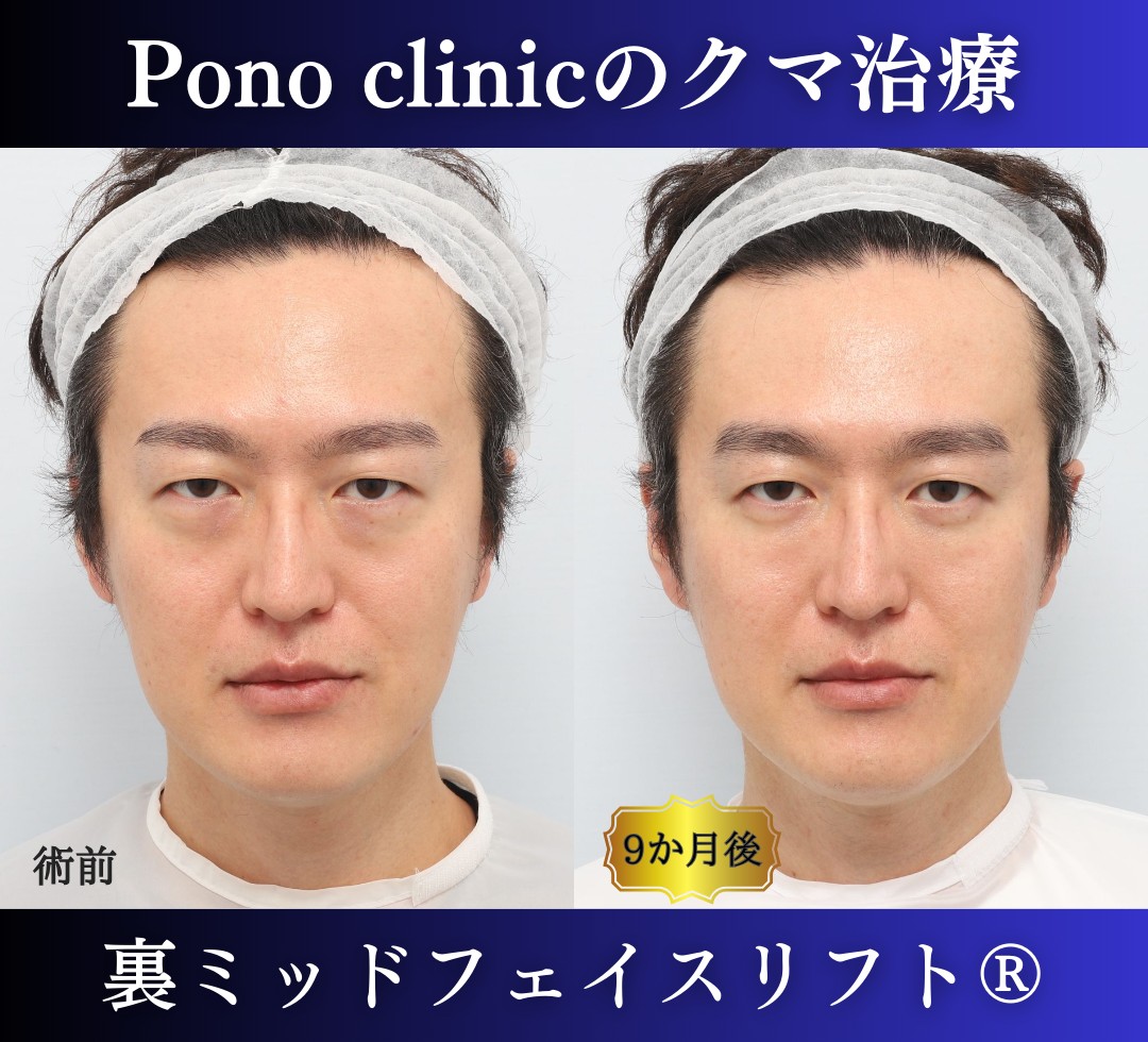 40代男性の症例、裏ハムラ法、目の下のクマ取り (8)