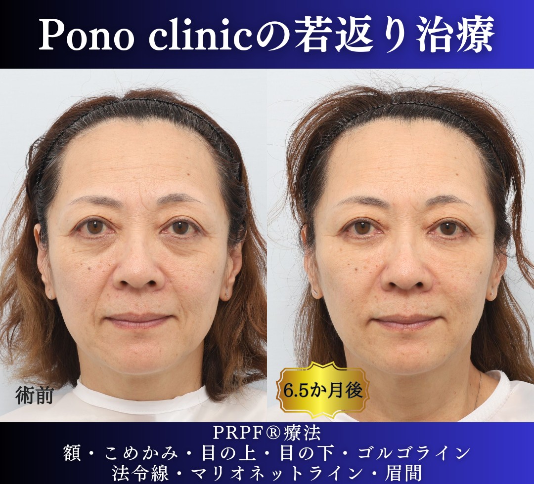 50代女性の症例、しわ取り、目の下のクマ取り、再生注射 (6)