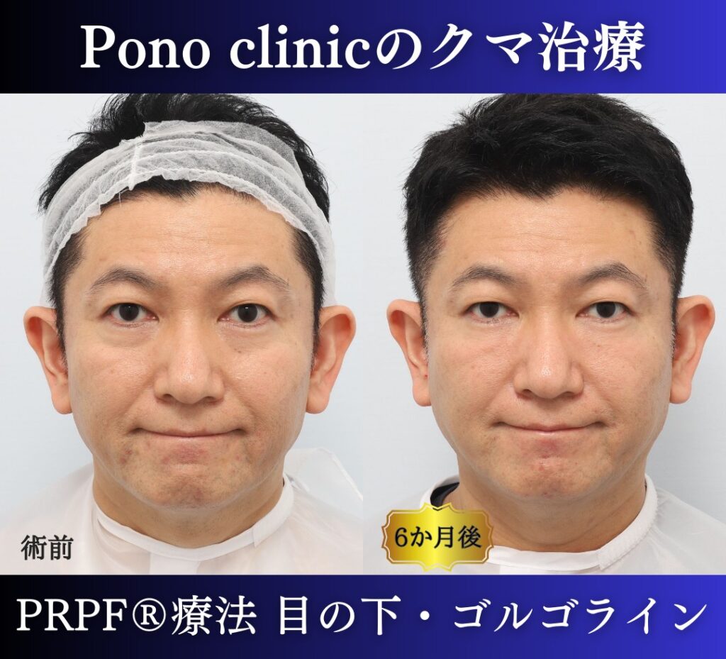 50代男性の症例、目の下のクマ改善、PRP注射 (2)