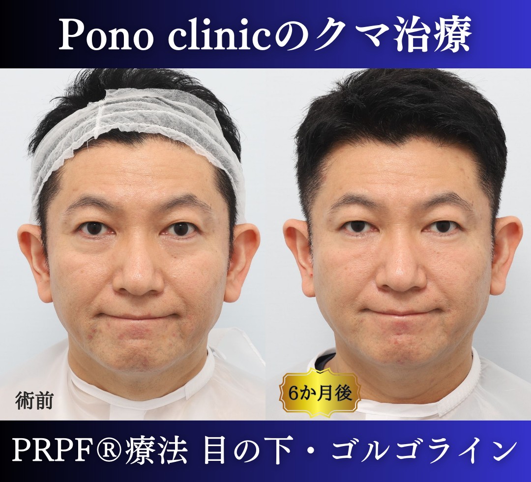 50代男性の症例、目の下のクマ改善、PRP注射 (2)