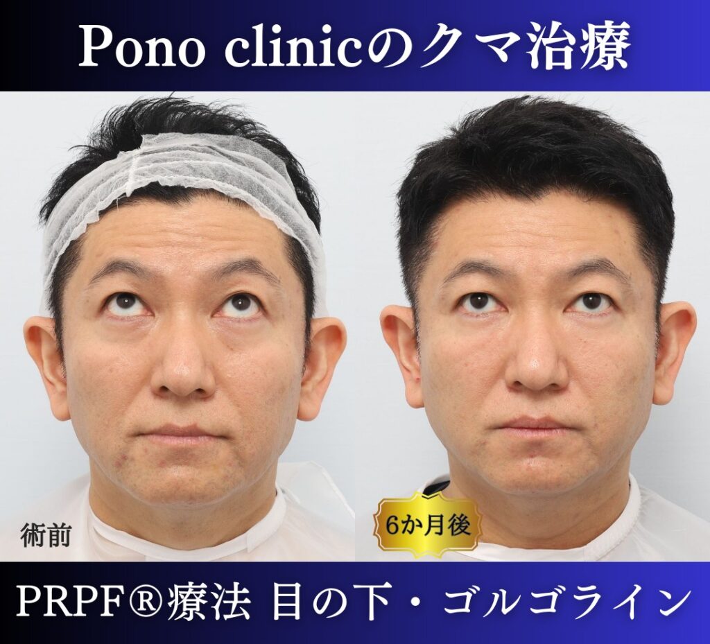 50代男性の症例、目の下のクマ改善、PRP注射 (3)