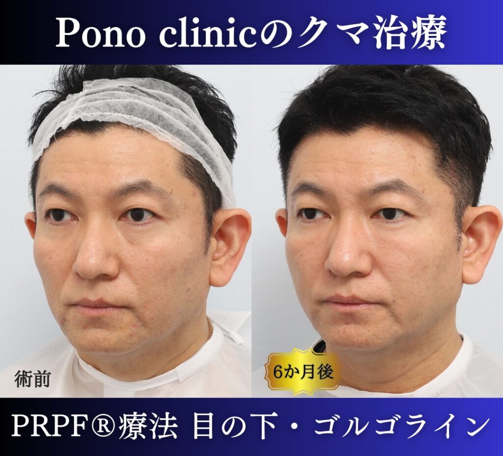 50代男性の症例、目の下のクマ改善、PRP注射 (5)