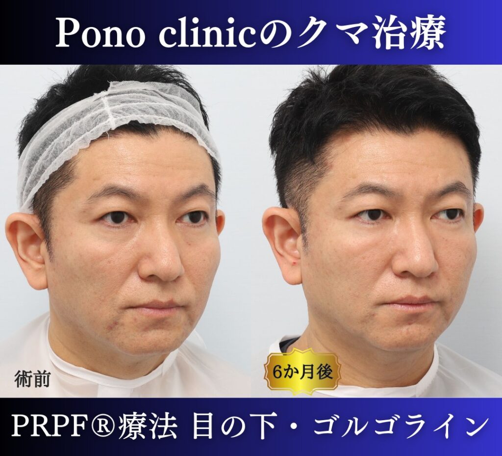 50代男性の症例、目の下のクマ改善、PRP注射 (6)