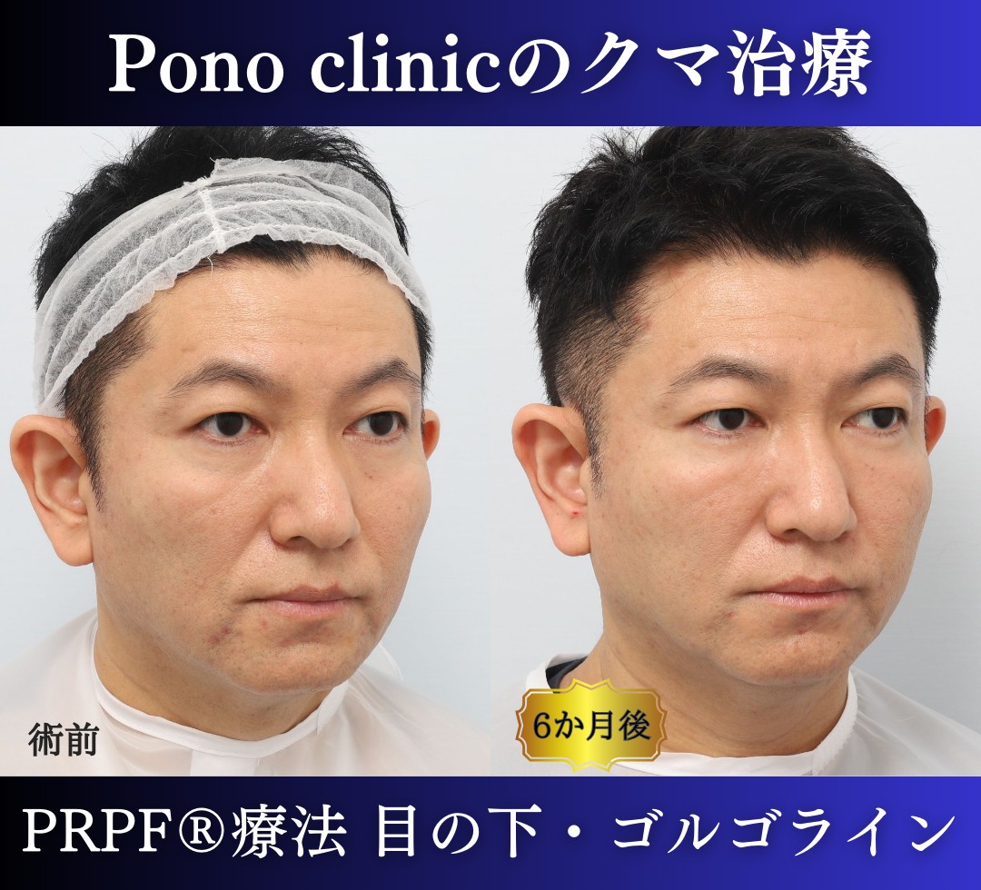 50代男性の症例、目の下のクマ改善、PRP注射 (6)