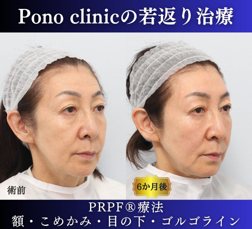 60代女性の症例、PRP注射、目の下のクマ、額形成 (1)