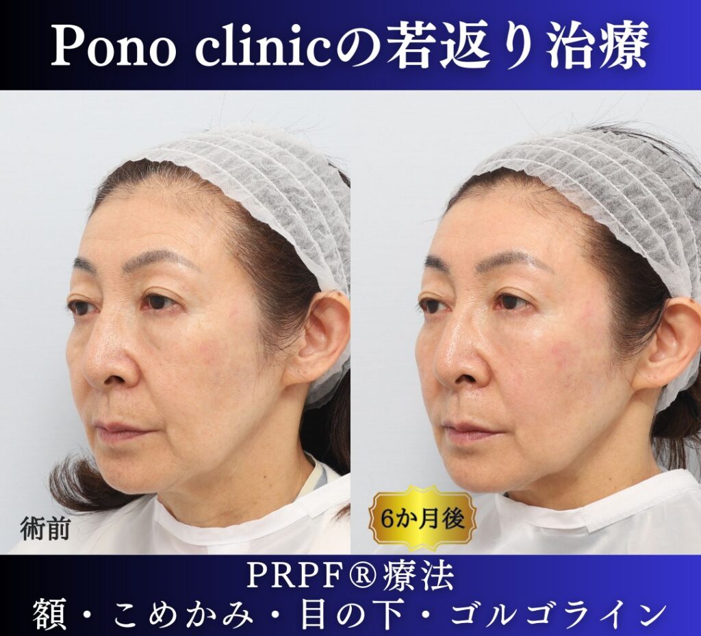 60代女性の症例、PRP注射、目の下のクマ、額形成 (2)