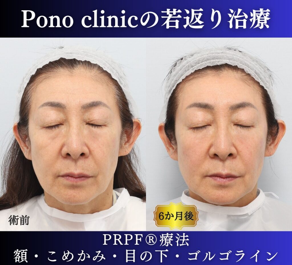 60代女性の症例、PRP注射、目の下のクマ、額形成 (4)