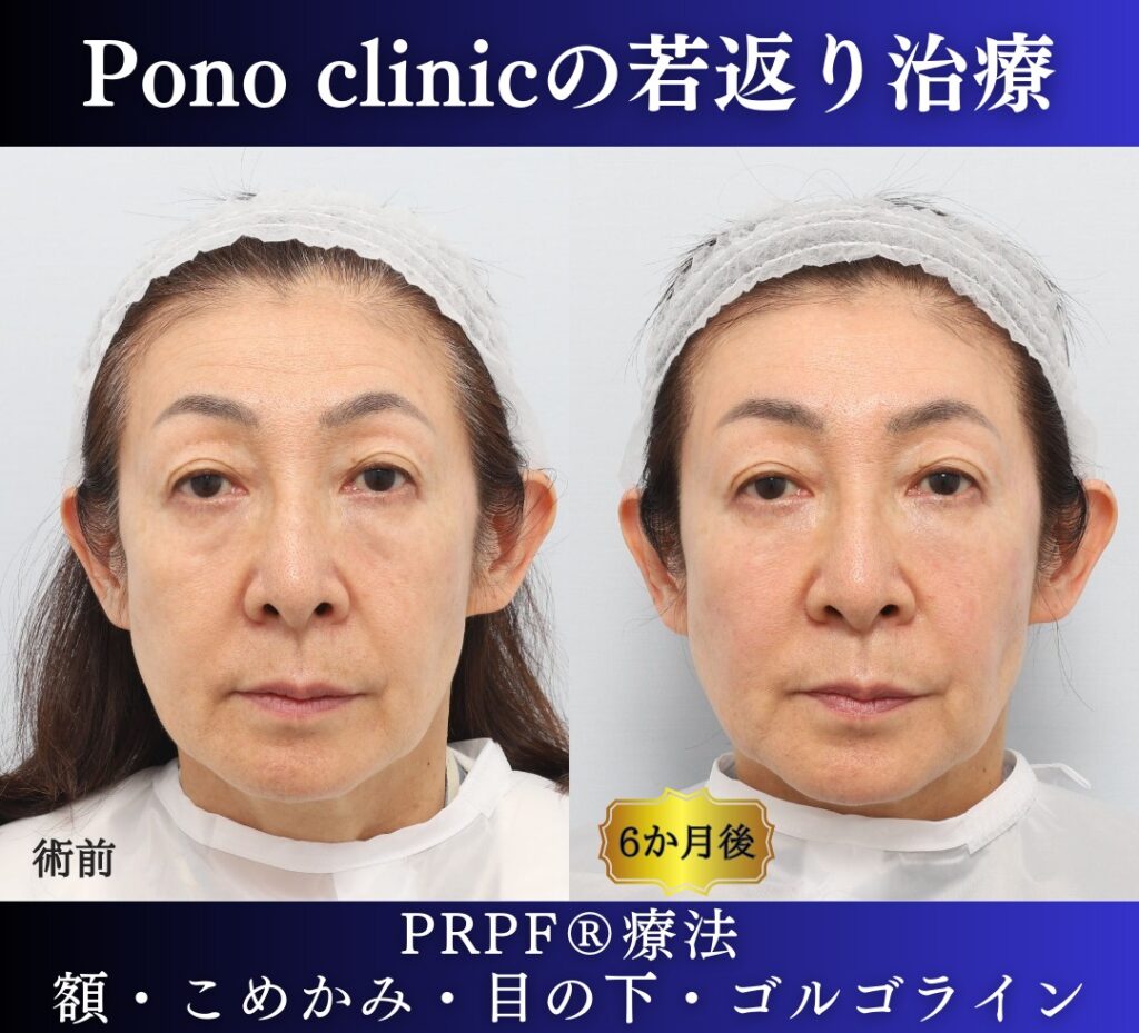 60代女性の症例、PRP注射、目の下のクマ、額形成 (5)