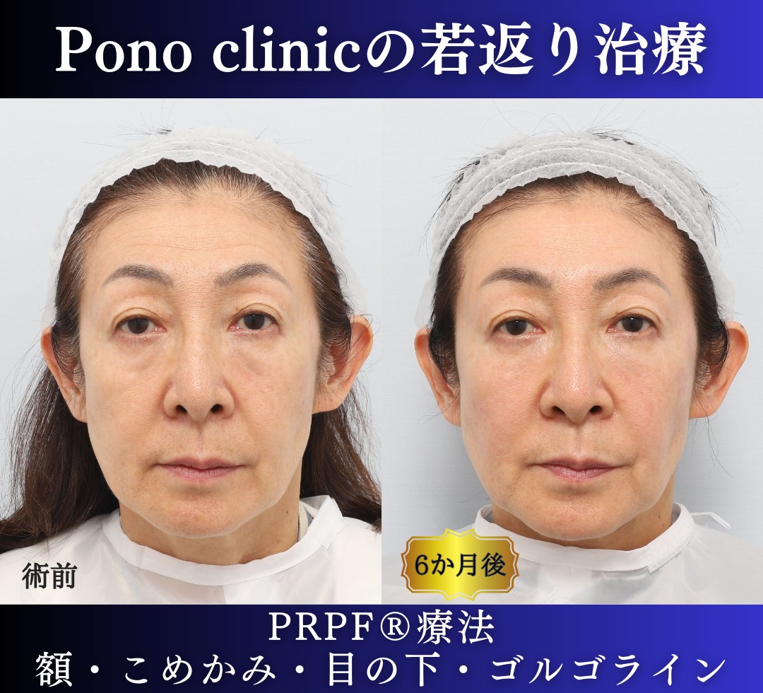 60代女性の症例、PRP注射、目の下のクマ、額形成 (5)