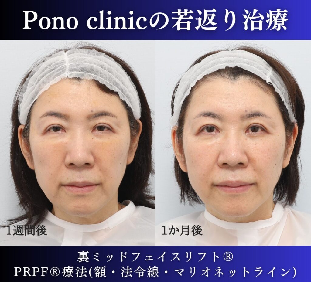 60代女性の症例、アンチエイジング治療、目の下のクマ取り、裏ハムラ (1)