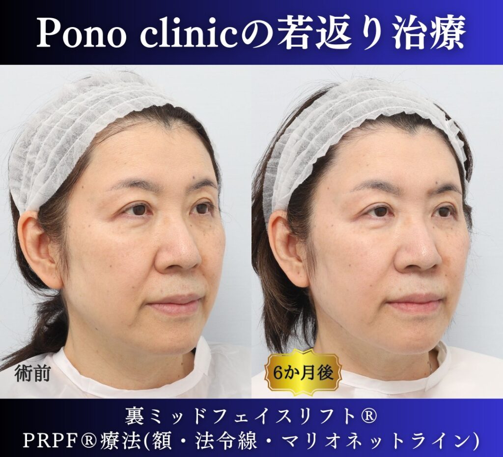 60代女性の症例、アンチエイジング治療、目の下のクマ取り、裏ハムラ (2)