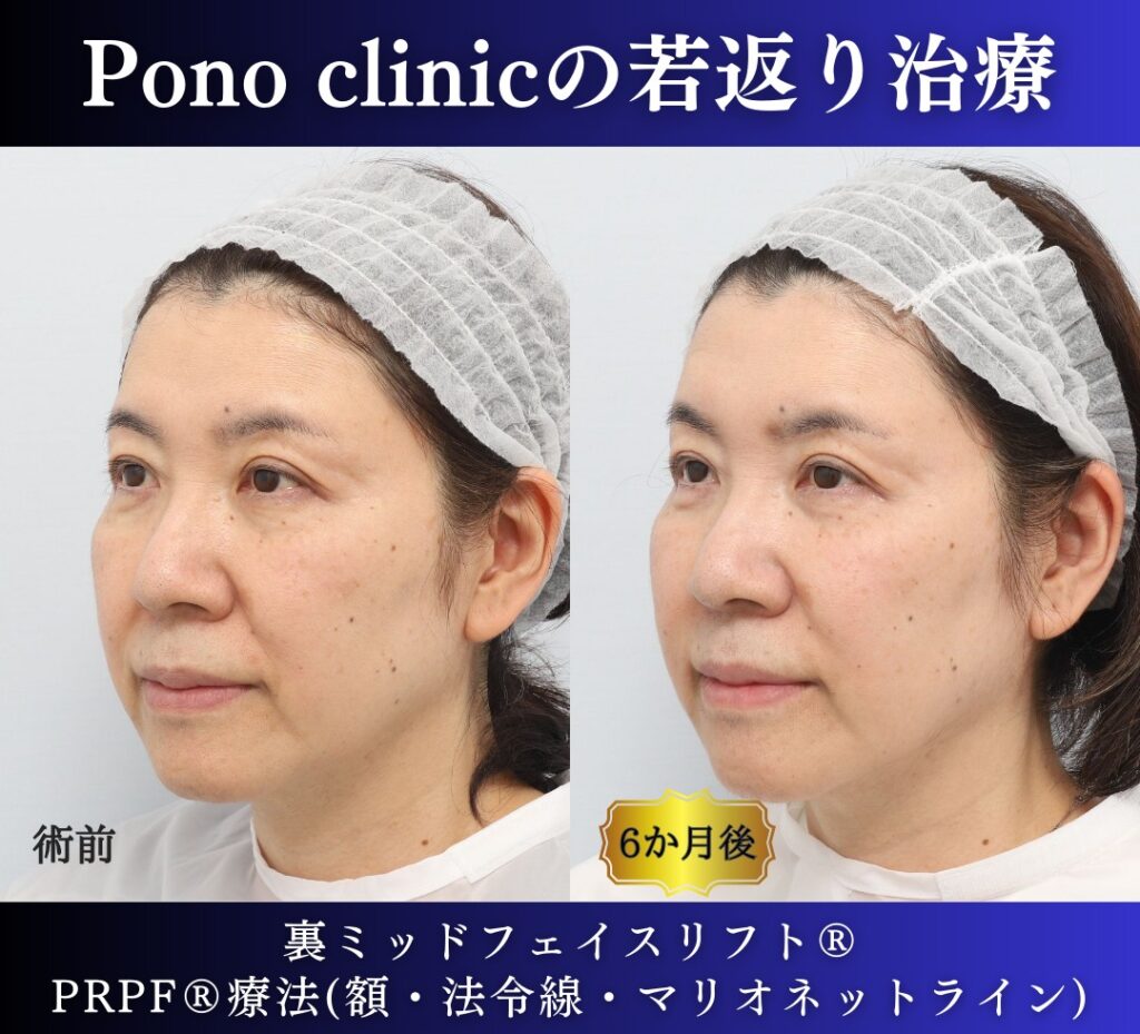 60代女性の症例、アンチエイジング治療、目の下のクマ取り、裏ハムラ (3)