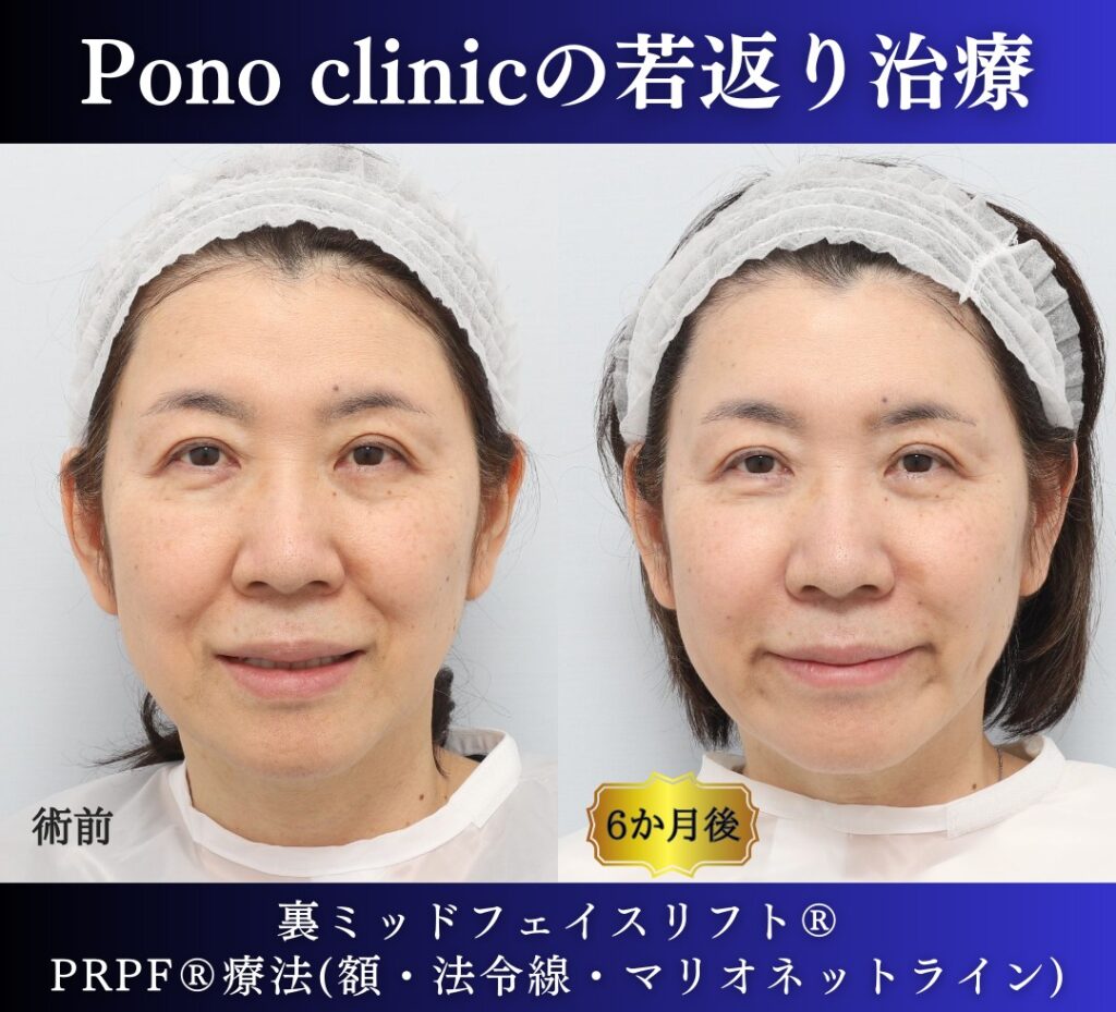 60代女性の症例、アンチエイジング治療、目の下のクマ取り、裏ハムラ (4)