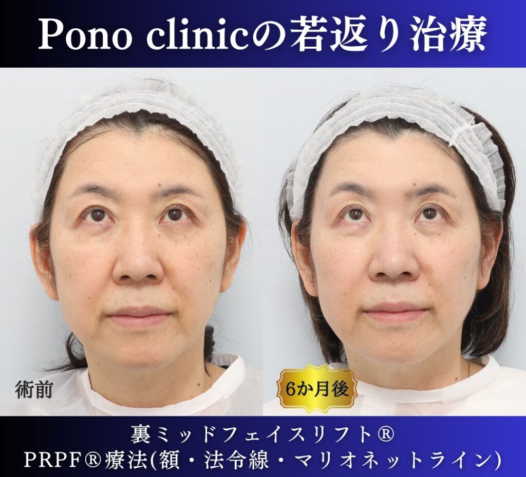 60代女性の症例、アンチエイジング治療、目の下のクマ取り、裏ハムラ (5)