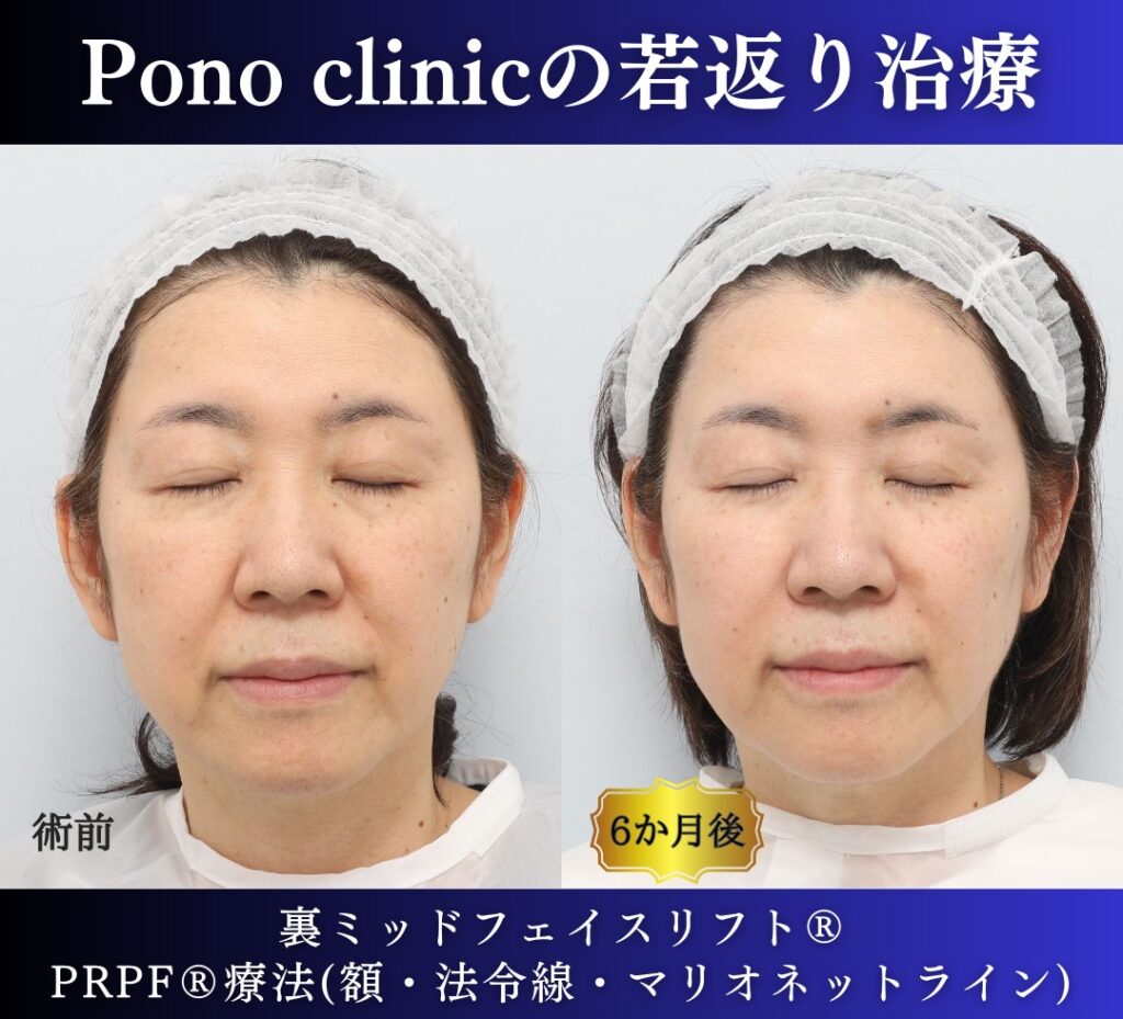 60代女性の症例、アンチエイジング治療、目の下のクマ取り、裏ハムラ (6)