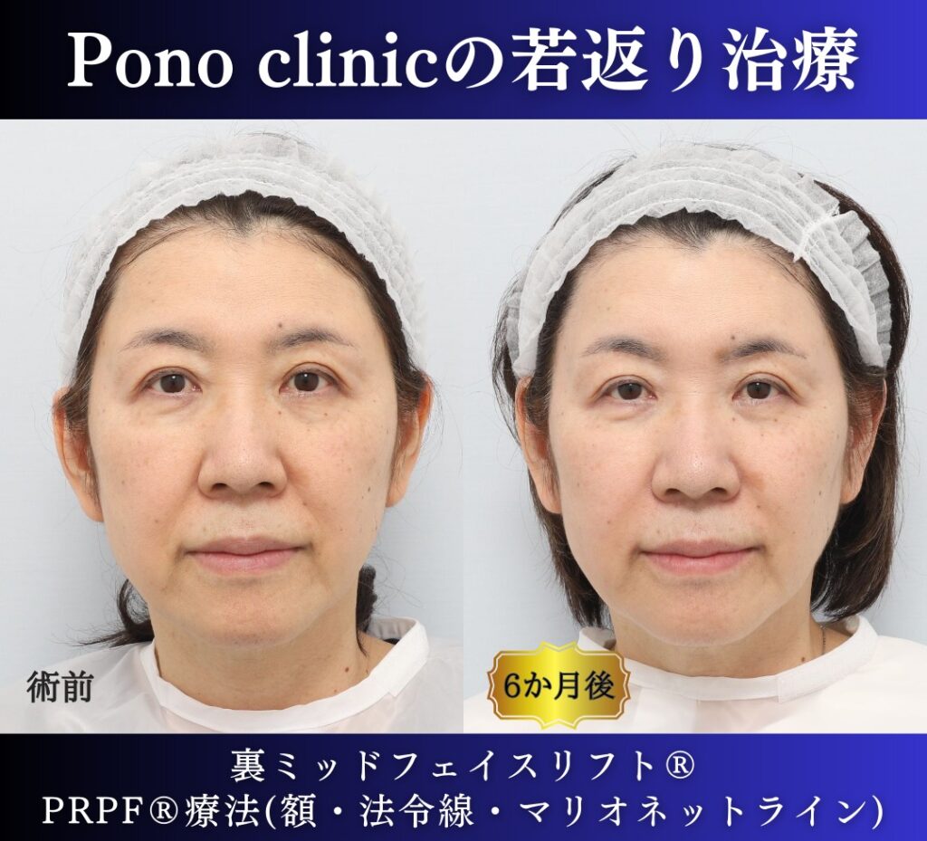 60代女性の症例、アンチエイジング治療、目の下のクマ取り、裏ハムラ (7)