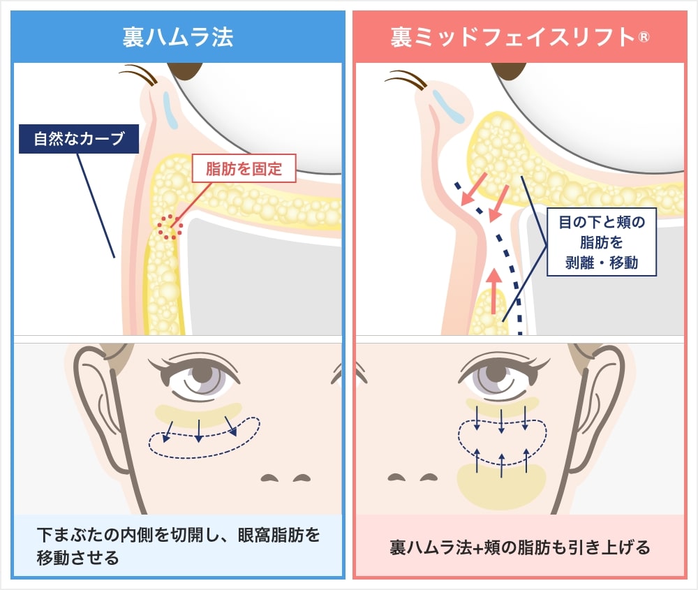 裏ハムラ法・裏ミッドフェイスリフト®の特長