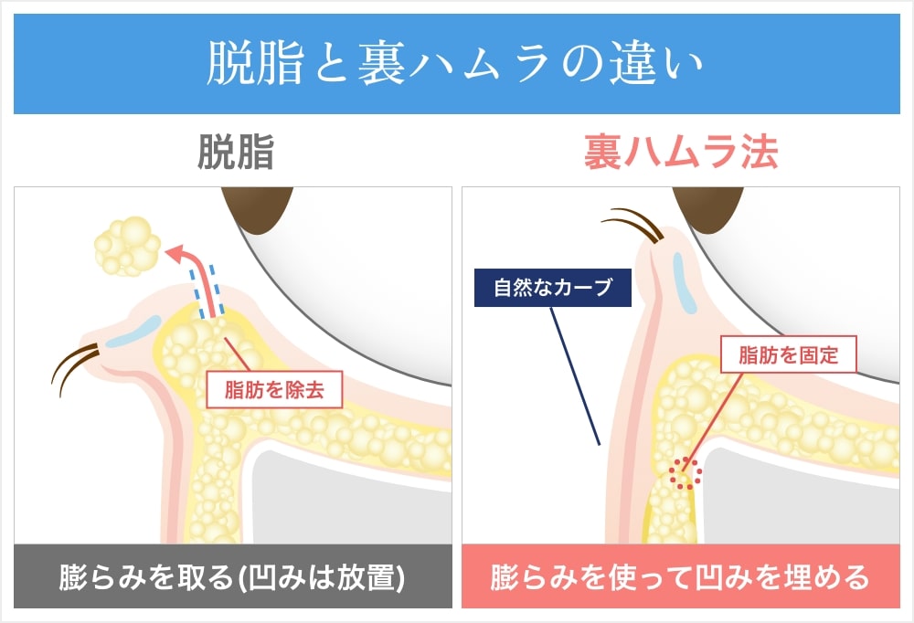 「切らないクマ取り」との違い