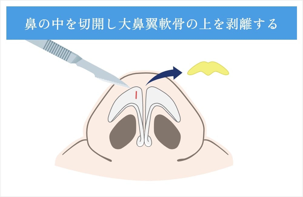 軟骨の上を剥離