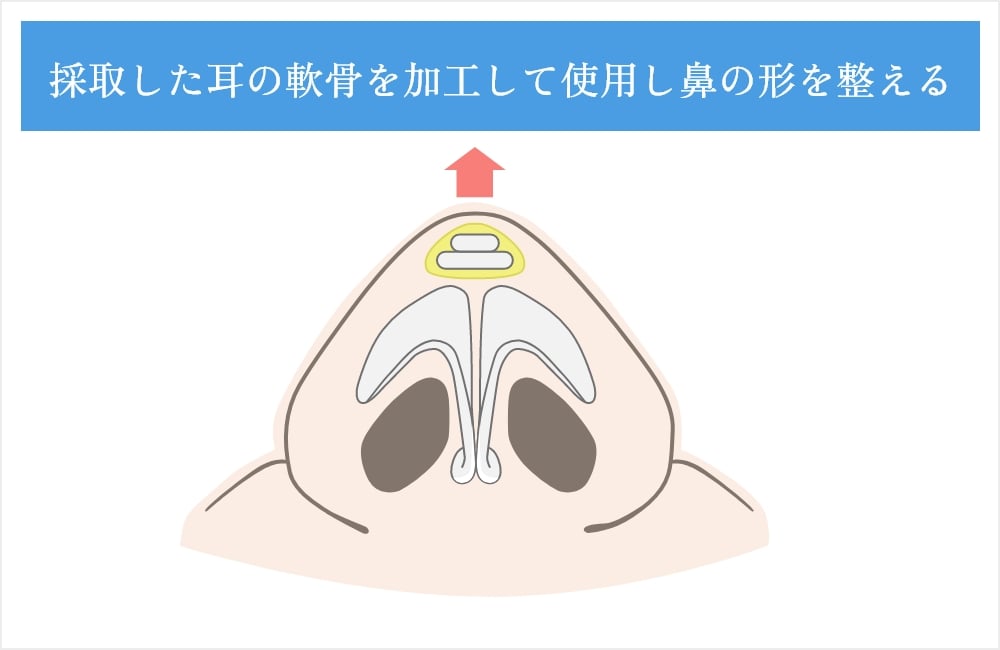 鼻の形を整える
