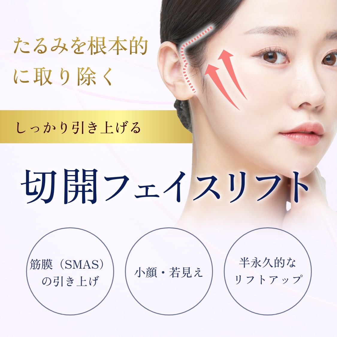 切開フェイスリフト-一覧SP
