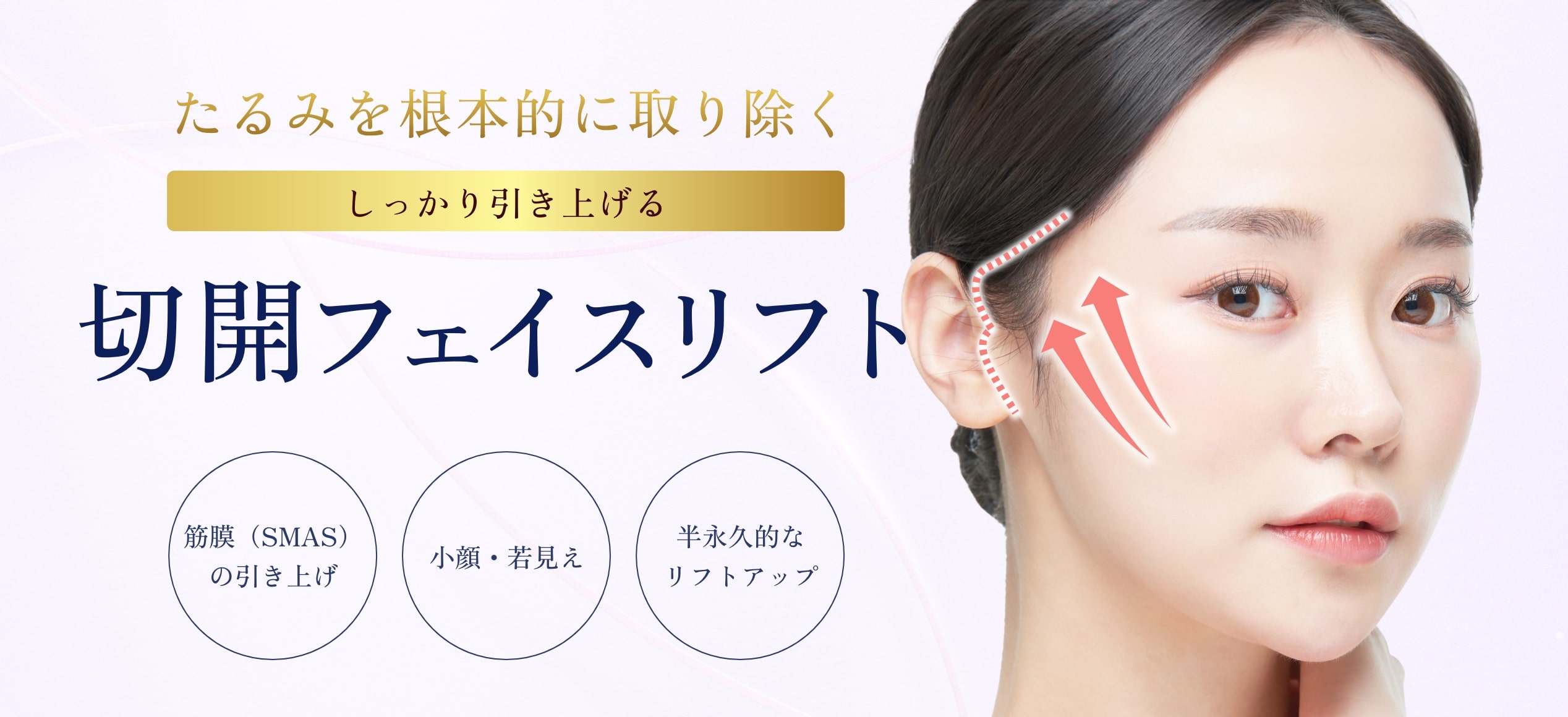 切開フェイスリフト-一覧