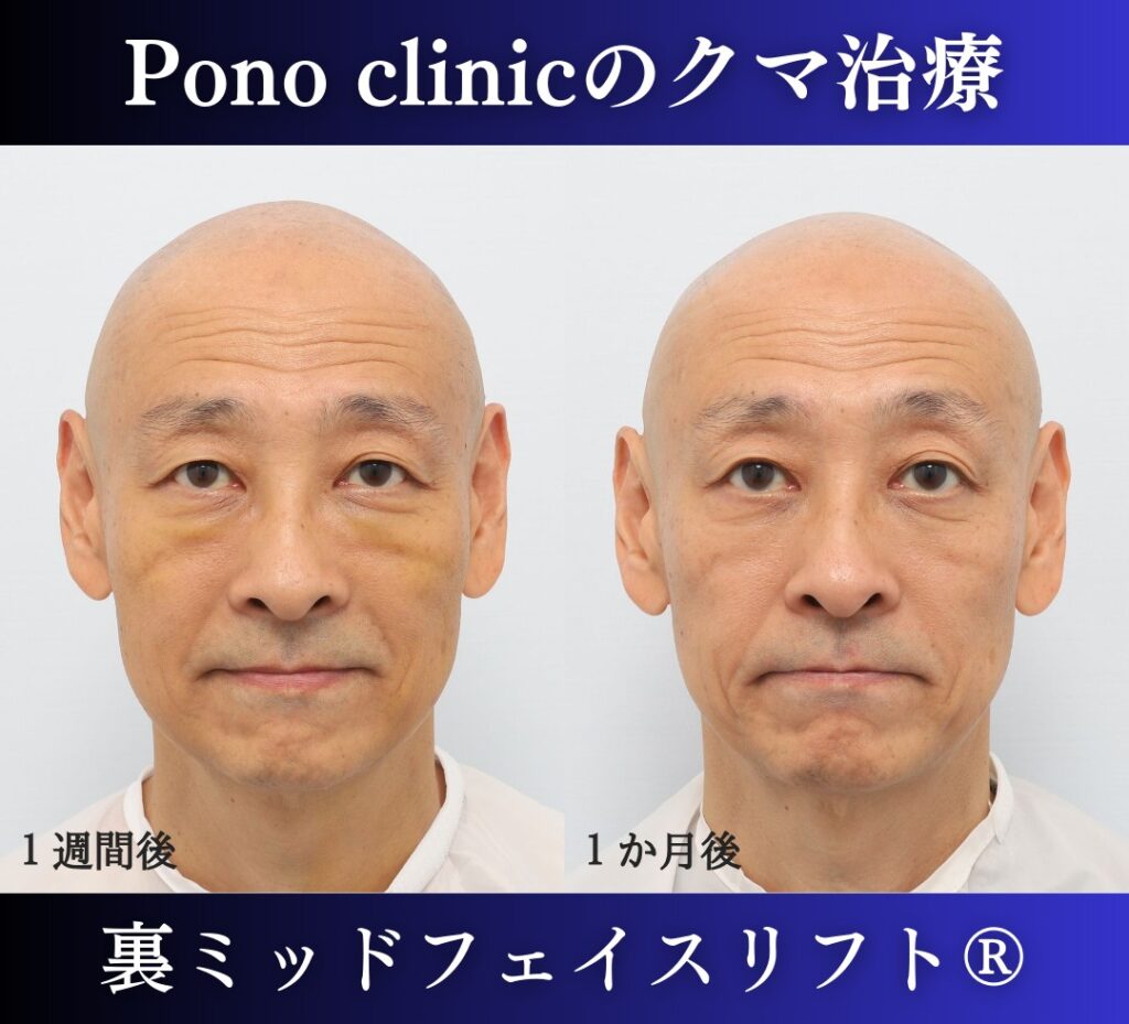 男性のクマ取り手術、裏ミッドフェイスリフト®、50代の症例 (1)