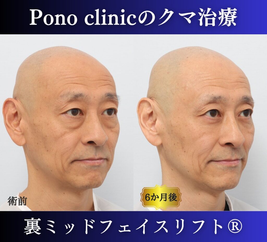 男性のクマ取り手術、裏ミッドフェイスリフト®、50代の症例 (2)