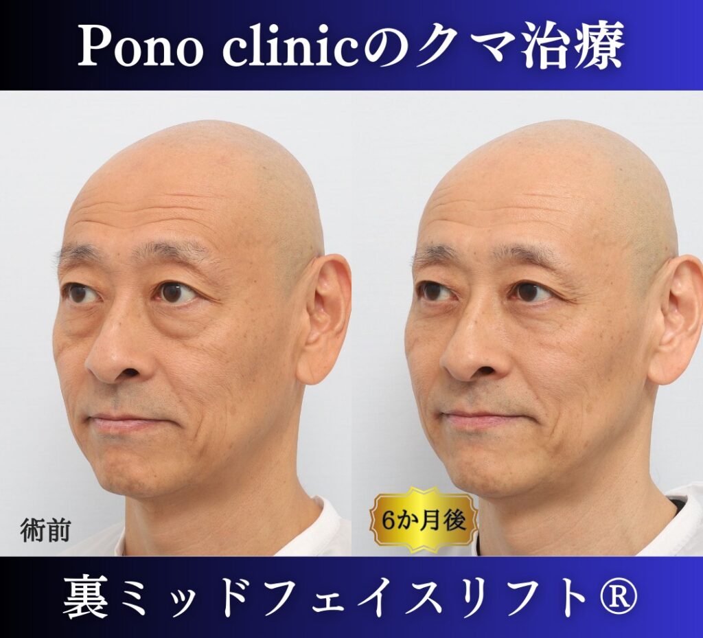 男性のクマ取り手術、裏ミッドフェイスリフト®、50代の症例 (3)