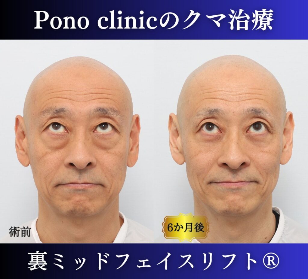 男性のクマ取り手術、裏ミッドフェイスリフト®、50代の症例 (5)