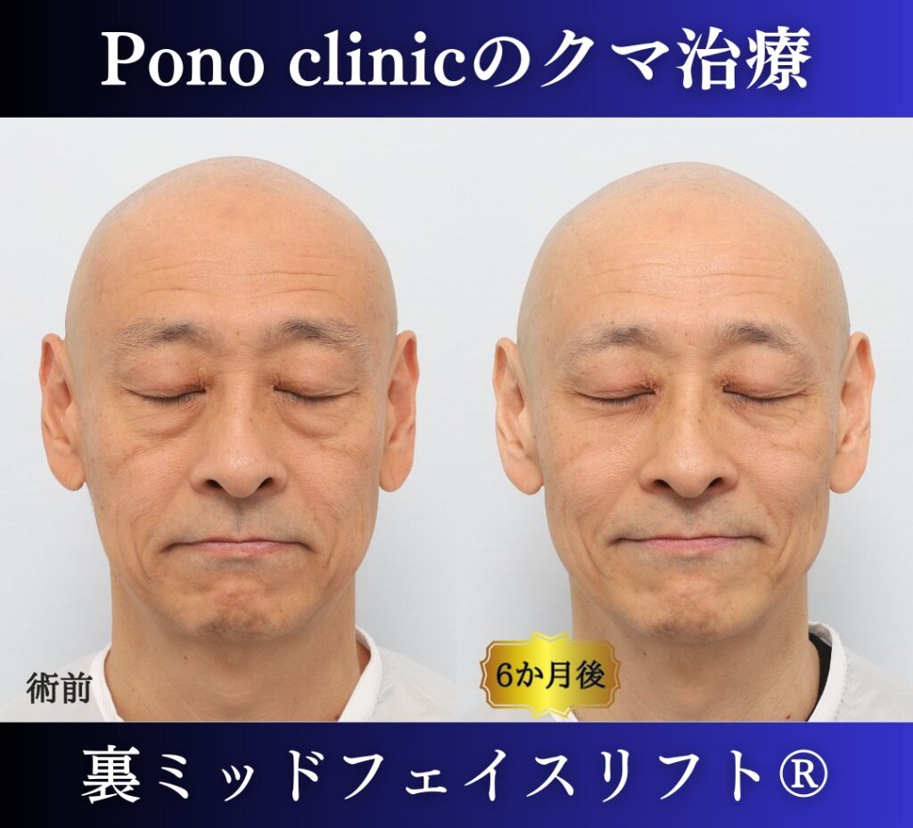 男性のクマ取り手術、裏ミッドフェイスリフト®、50代の症例 (6)