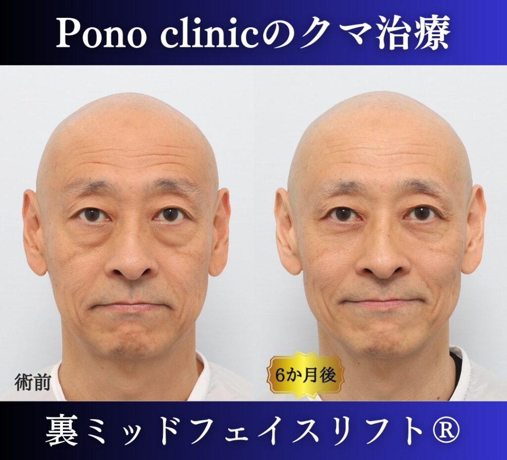 男性のクマ取り手術、裏ミッドフェイスリフト®、50代の症例 (7)