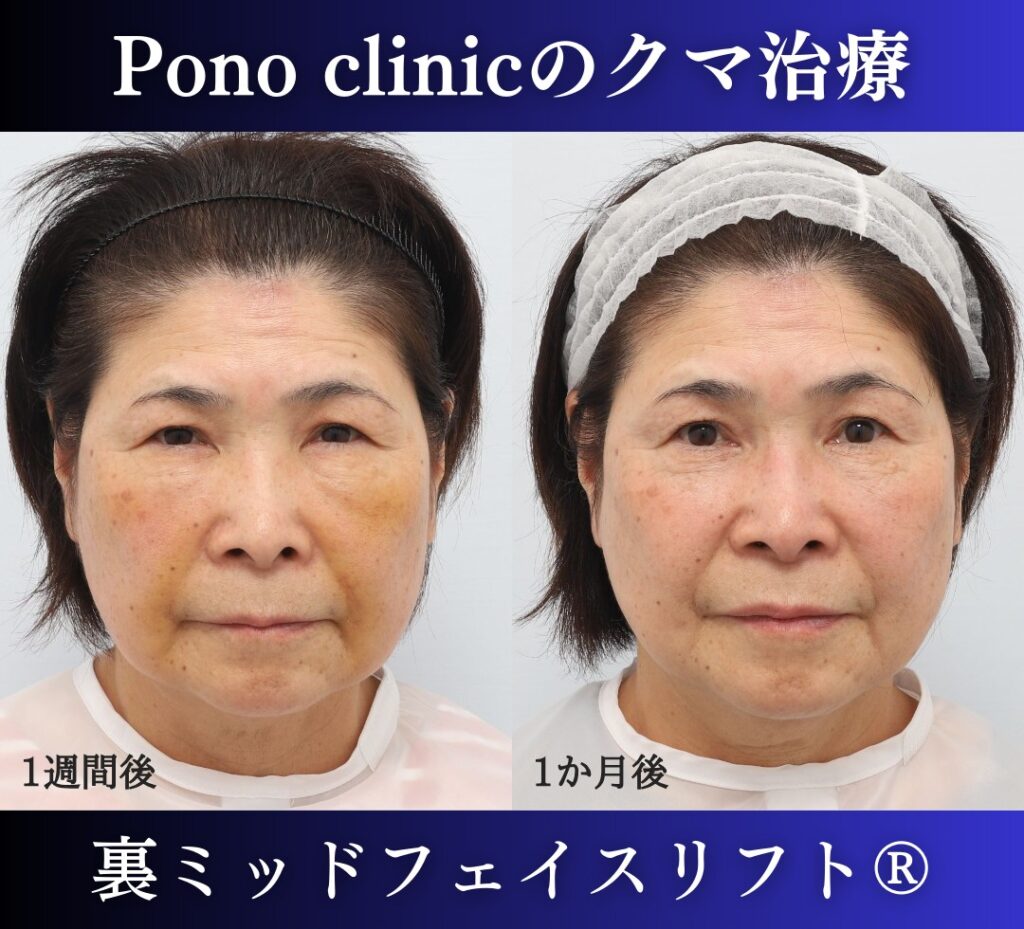 目の下のたるみ、クマ取り、60代女性の症例 (1)