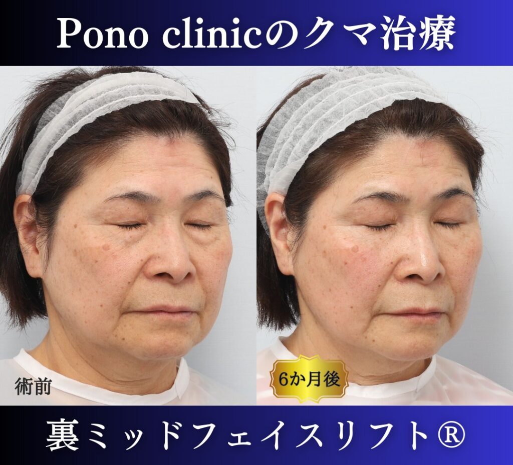 目の下のたるみ、クマ取り、60代女性の症例 (2)