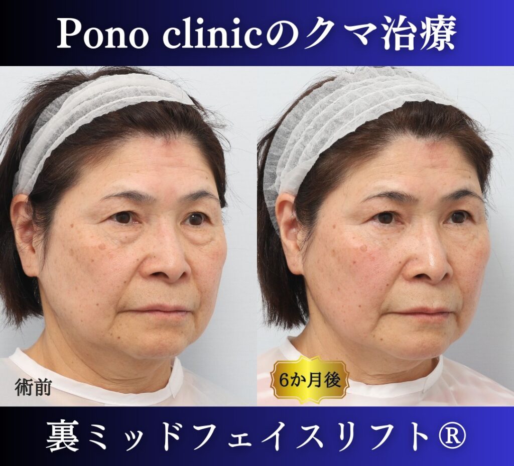 目の下のたるみ、クマ取り、60代女性の症例 (3